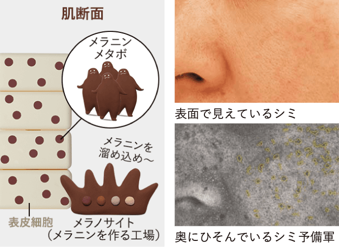 図：肌断面＋写真：表面で見えているシミ＋写真：奥にひそんでいるシミ予備軍